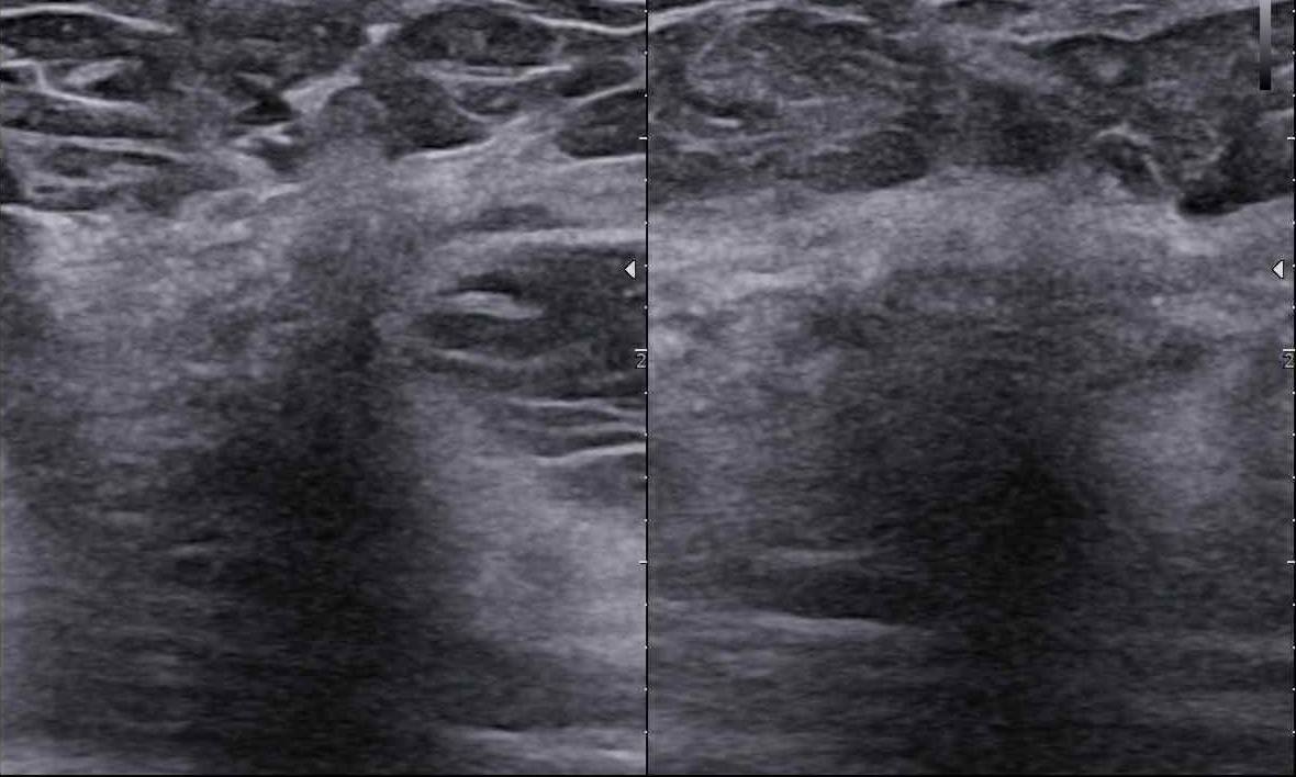 Czy podział BIRADS 4 ma sens? Jak radzić sobie  z BIRADS 4a, b, c?